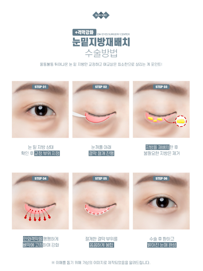 눈 밑 개선으로 환한 동안 인상 되기 관련 이미지 4