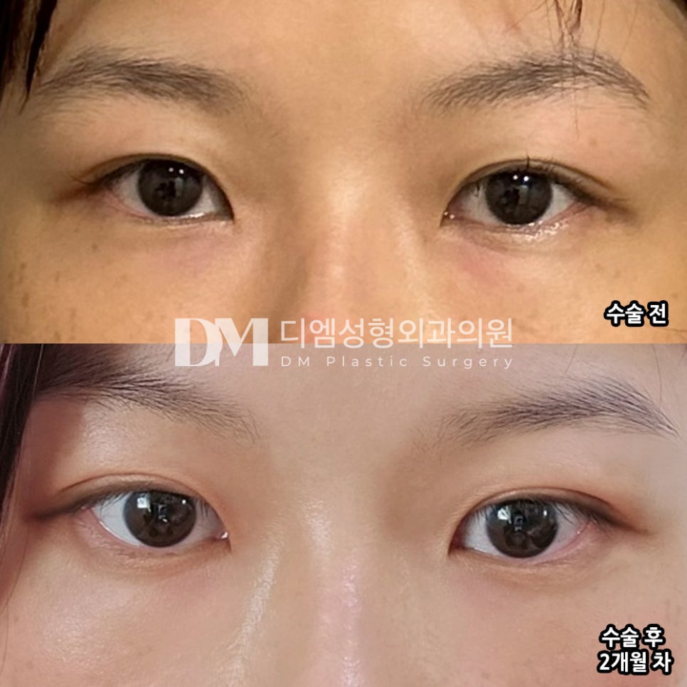 눈재수술 후기."시술 결과가 만족스러운편이고, 주변에서 벌써 괜찮다는 말을 많이 들었습니다 !" 관련 이미지 2