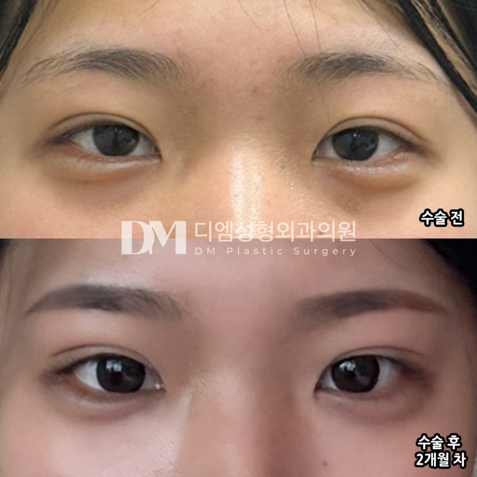 Bbang Ttimum Review. "I was glad I could get two types of canthoplasty at a good price at the same time!" image 2