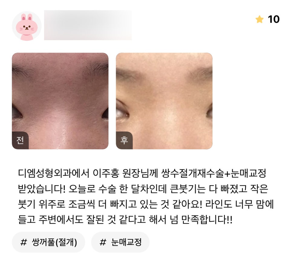 눈재수술 후기."라인도 너무 맘에들고 주변에서도 잘된 것 같다고 해서 너무 만족입니다!" 관련 이미지 1