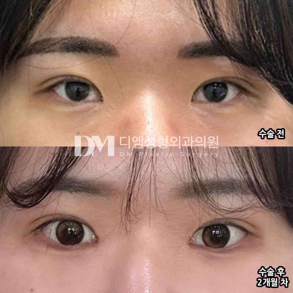 트임성형 후기."살빠져서 눈이 커진 줄 알정도로 자연스러워요!" 관련 이미지 2