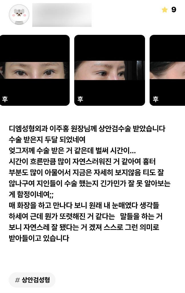 Eyelid Surgery Review: “It looks so natural that even people I know can’t really tell!” image 1