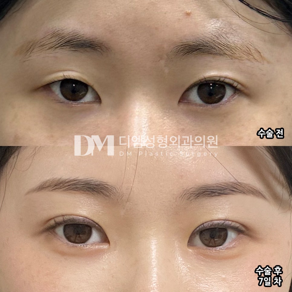 눈재수술 후기."비대칭이 너무 잘 잡혀서 좋습니다" 관련 이미지 2