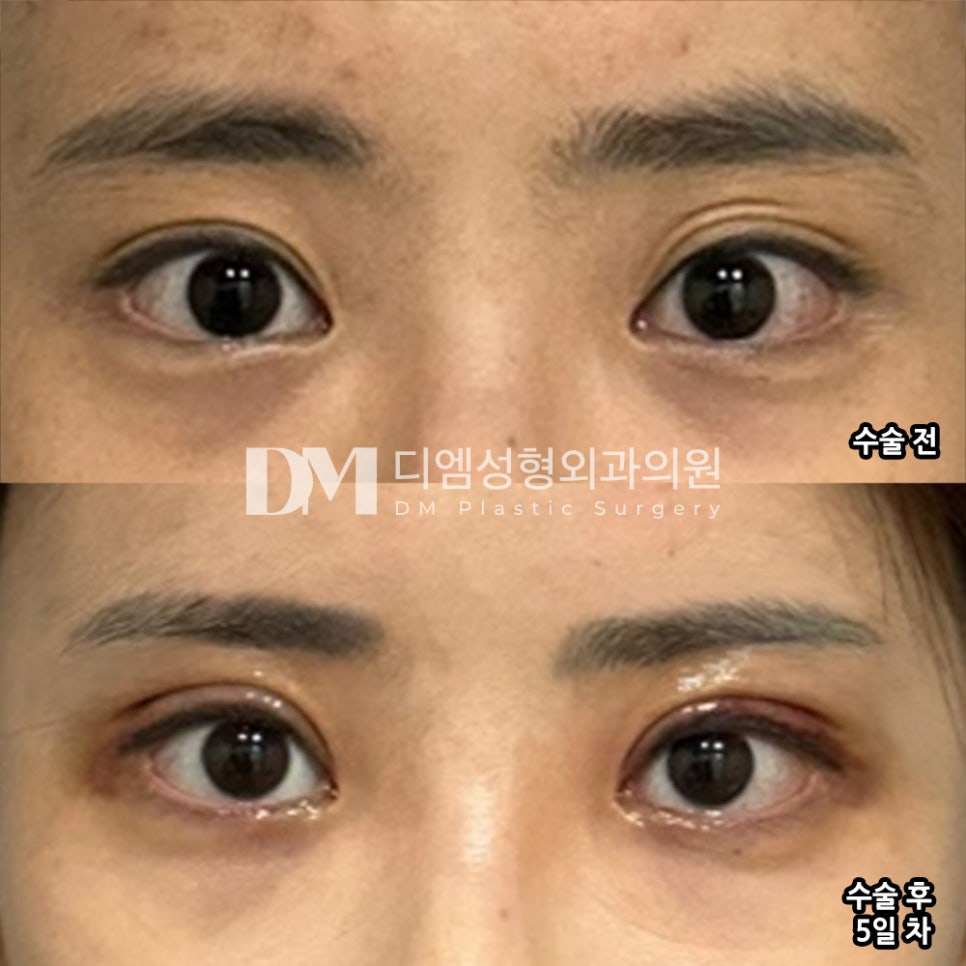 눈재수술 후기."겹주름이 사라지고 쌍꺼풀 라인이 또렷해져서 너무 좋아요!" 관련 이미지 2