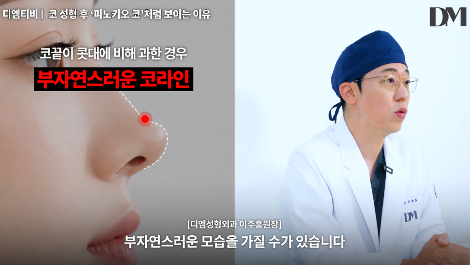 코성형 후 피노키오 코처럼 보이는 이유, 코가 높아서일까요? 관련 이미지 7