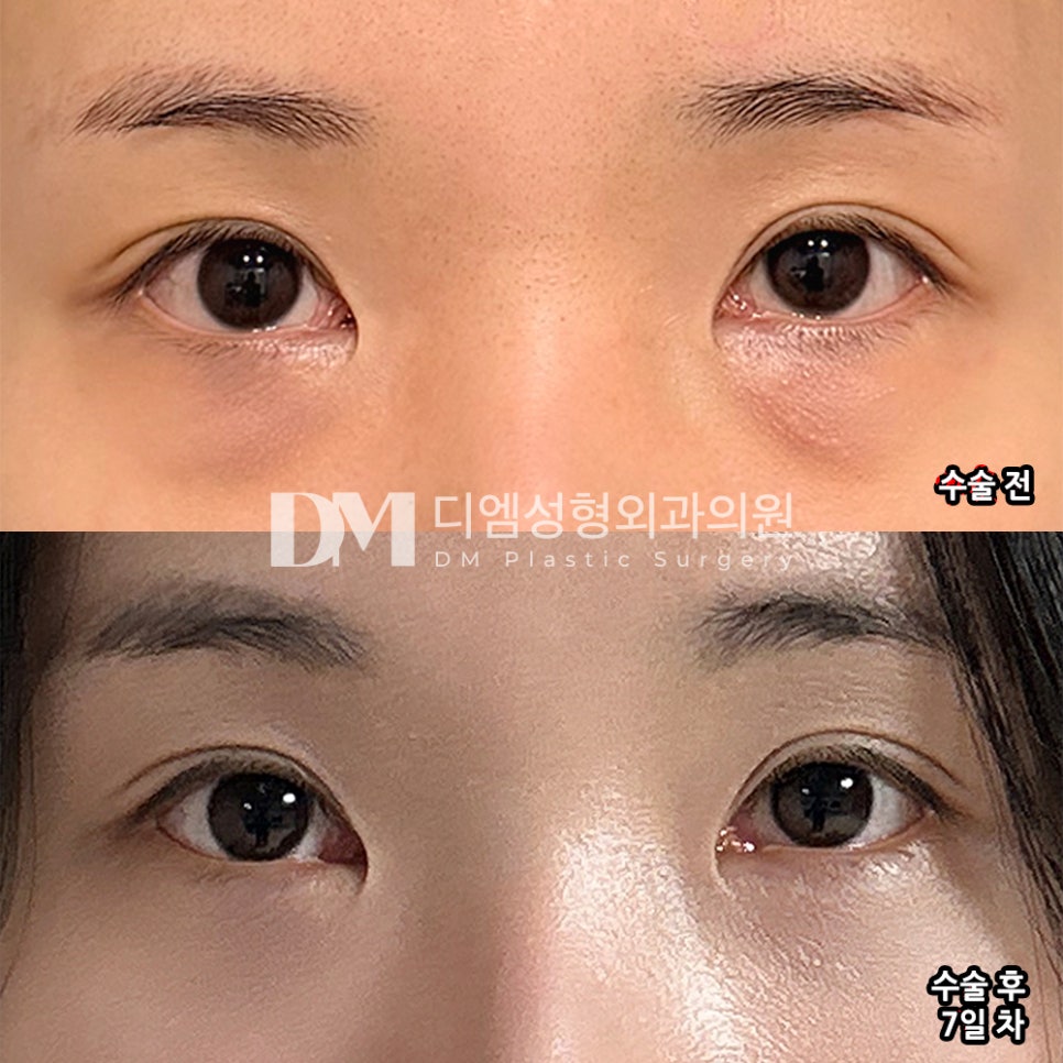 디엠 눈밑지방재배치 전후사진, 화장으로 가려지지 않는 눈 밑 개선 완료! 관련 이미지 2