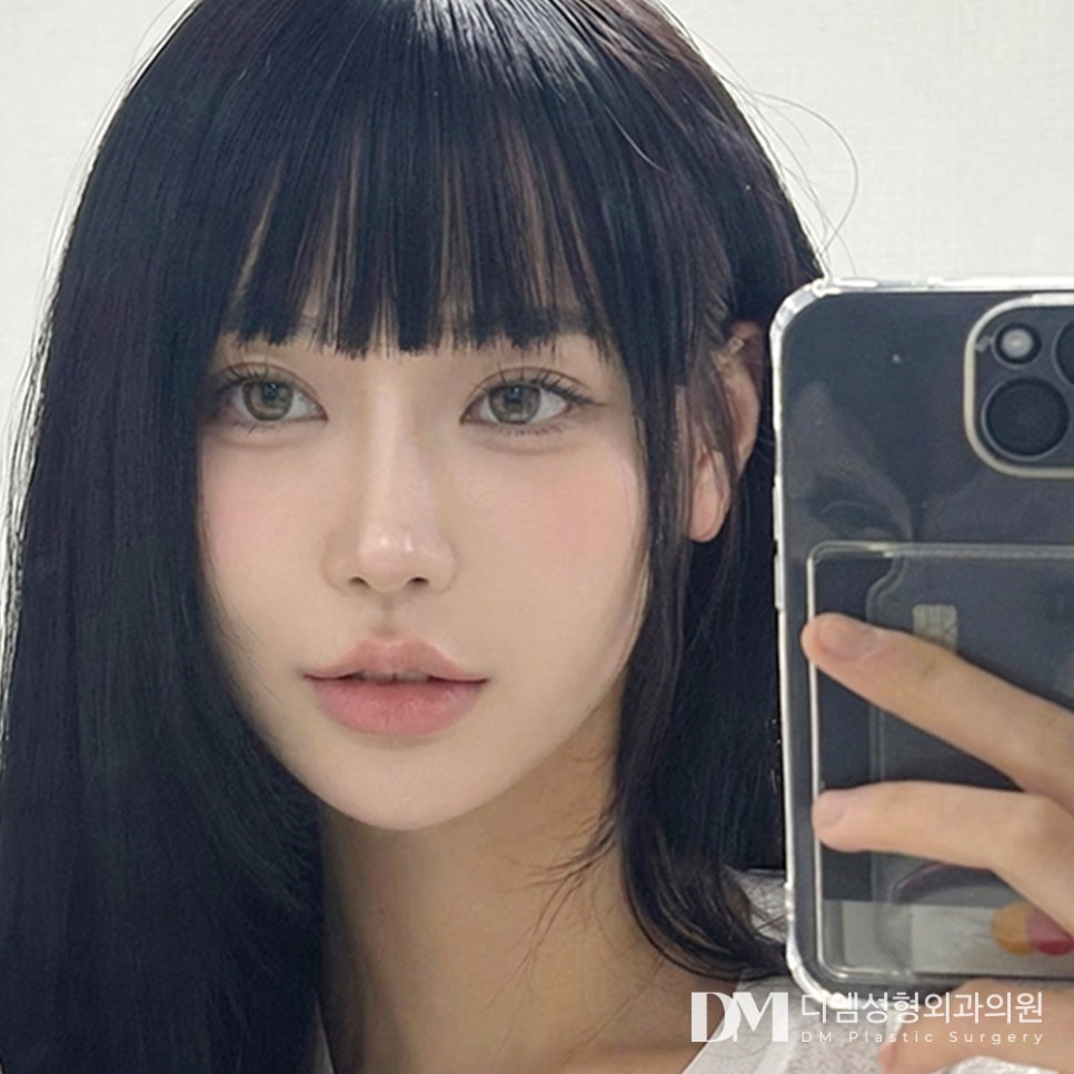 뒤밑트임 전후사진, 답답하고 사나운 눈매 개선 가능할까? 관련 이미지 1
