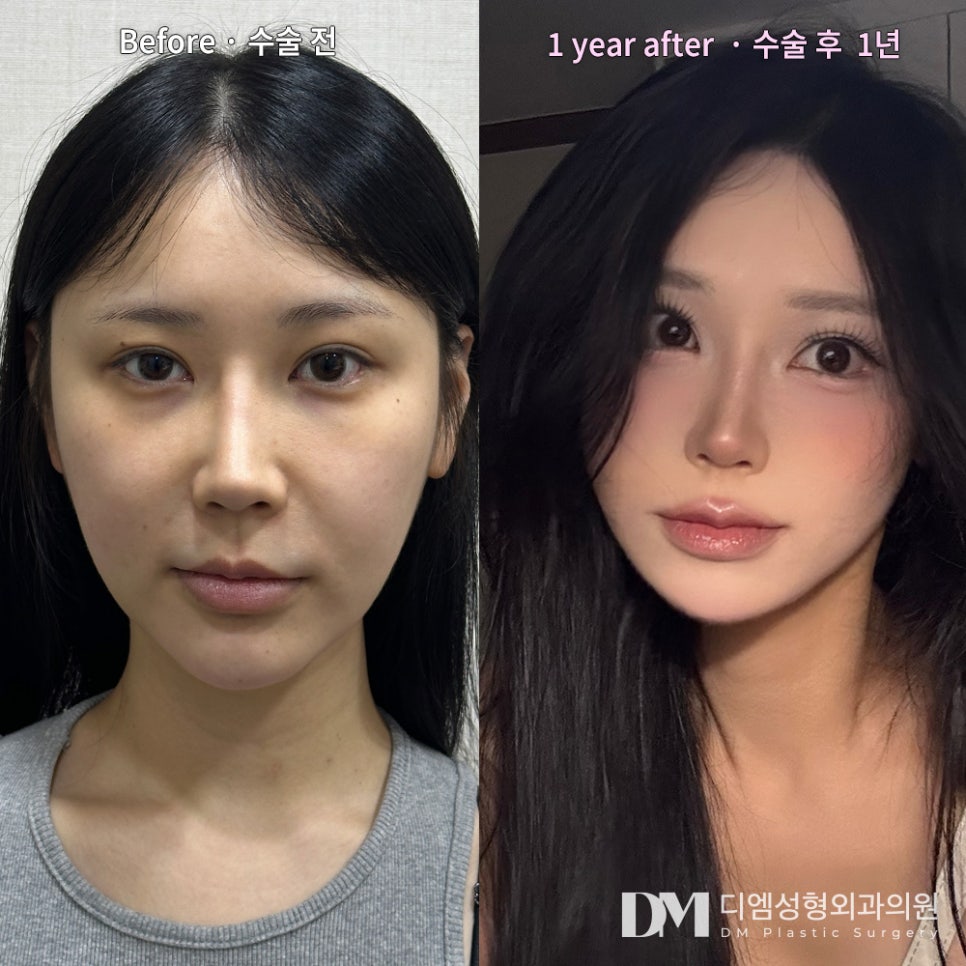 성형 후기."하루하루 만족하며 지내고 있어요!" 관련 이미지 2