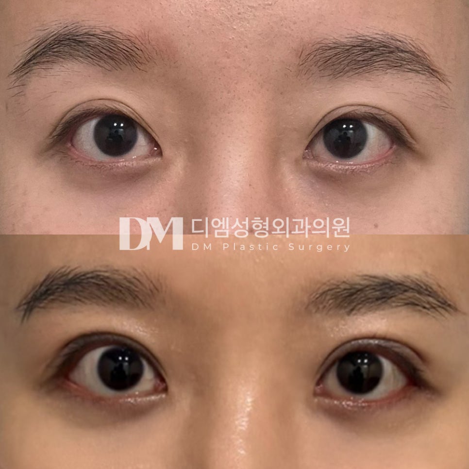 눈성형 후기."확실히 또렷하고 어려보이는 것 같아 만족스러워요!" 관련 이미지 2