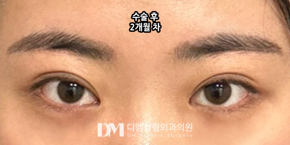 Double-Eyelid Surgery: Looking Your Best for Spring image 9