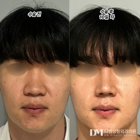 복코성형, 뭉툭한 인상 개선하기 관련 이미지 10