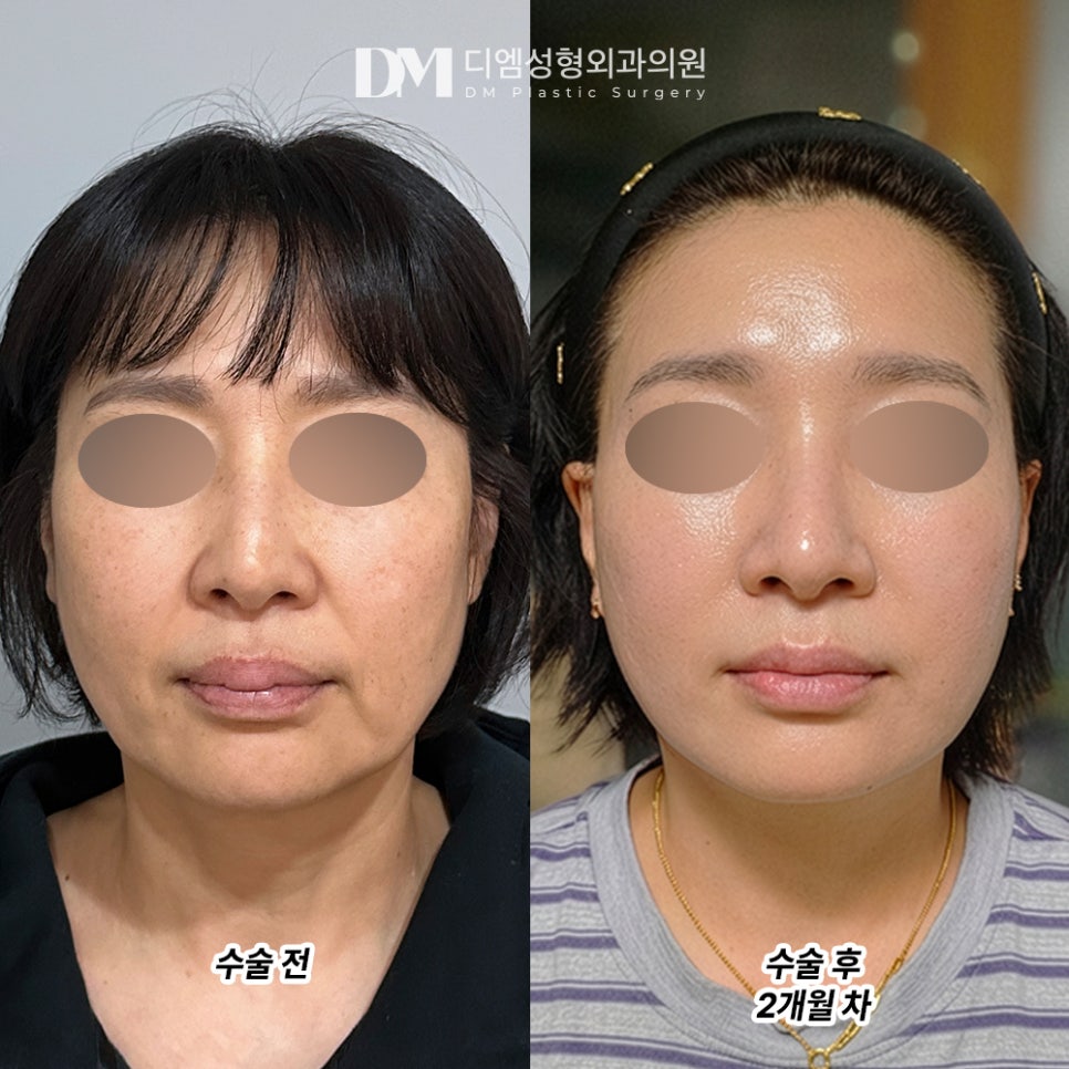 안면거상, 젊은 시절의 나를 되찾고 싶다면 관련 이미지 5