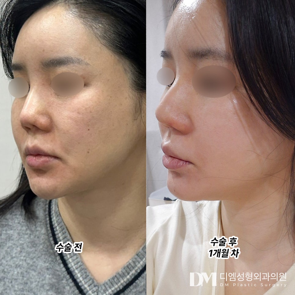 Improving Smile Lines Caused by Sagging Cheeks with a Partial Facelift image 7