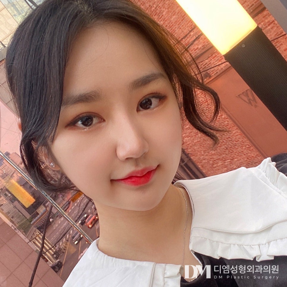 Canthoplasty for the outer and lower corners: improving your look as well as eye size! image 9