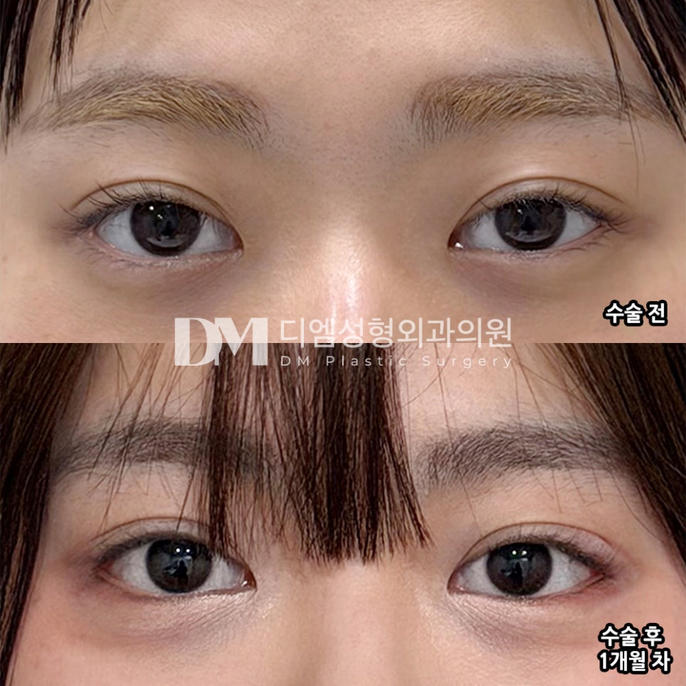 디엠 빵트임/트임성형 후기, &ldquo;결과적으로 정말 잘한 선택이라고 생각합니다!&rdquo; 관련 이미지 2