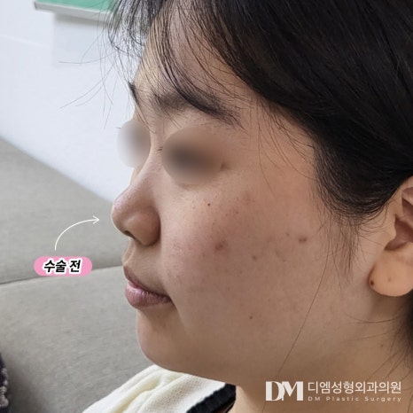 동양인에 흔한 짧은코 수술방법과 주의해야 할 점은? 관련 이미지 8