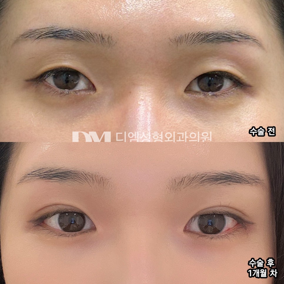 Eye Surgery Review. “Everyone says my eye shape looks gentle and bright now!” image 2