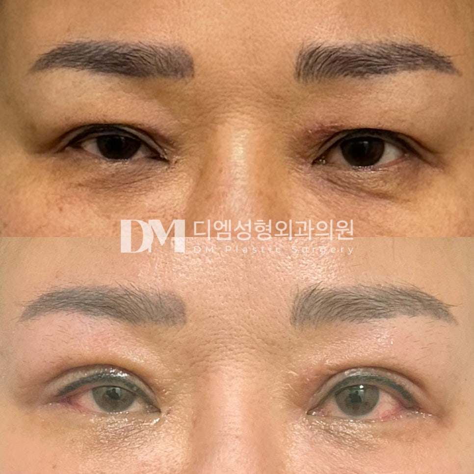 눈성형 후기."깔끔히 몰라보게 잘됐어요!" 관련 이미지 2