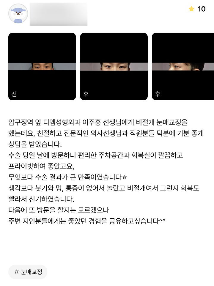 Eyelid Surgery Review. “I was amazed at how quickly I recovered, and I’m very satisfied!” image 1