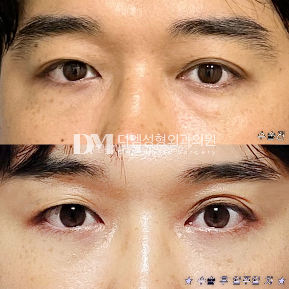 눈밑지방재배치, 불룩해진 눈밑 매끈하게 되살리기! 관련 이미지 6