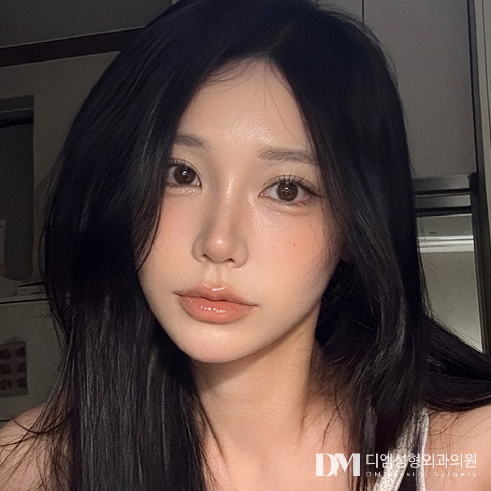 DM Facial Fat Grafting Before-and-After Photos: What’s the Secret to Natural Results Without Overdoing It? image 4