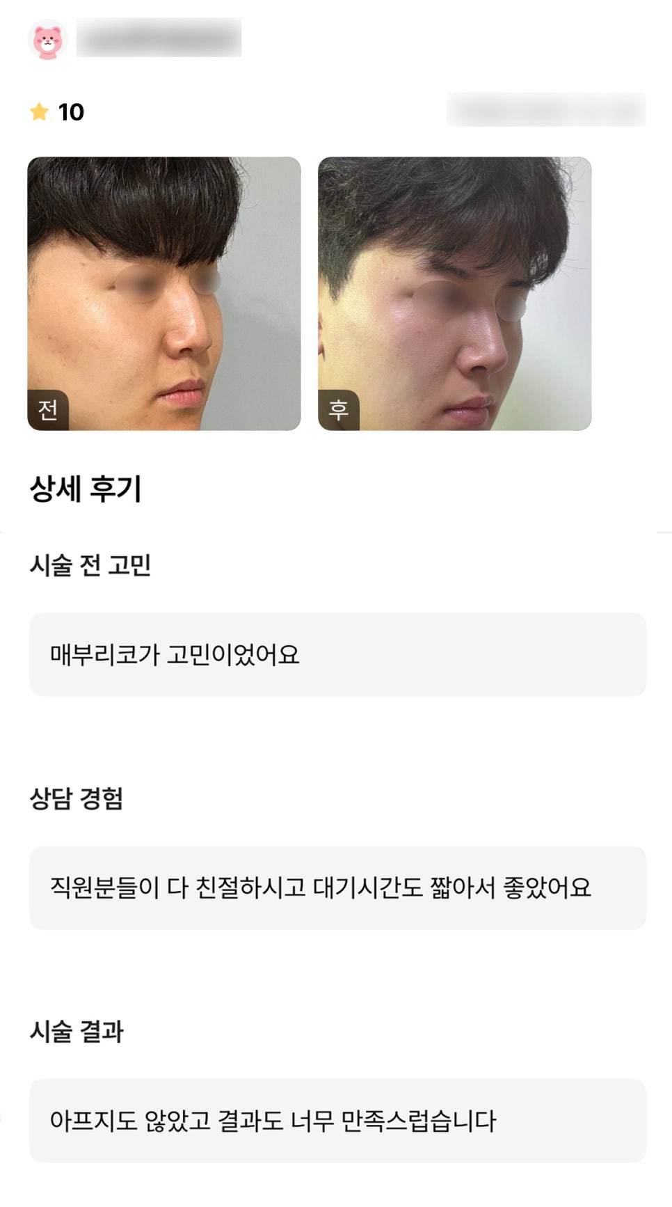 Rhinoplasty Review. “It didn’t hurt, and I’m very satisfied with the result!” image 1
