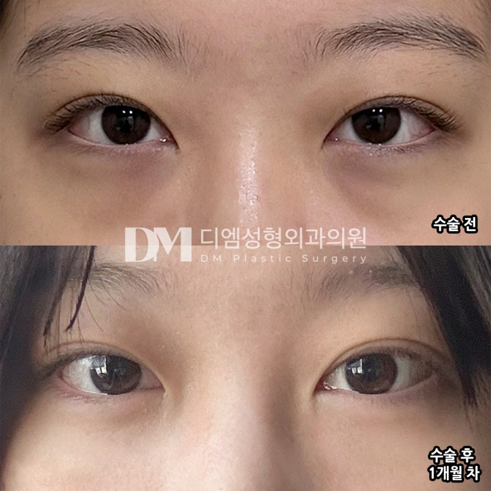 디엠 눈밑지방재배치 전후사진, 칙칙함 싹 지우고 환한 눈매로 변신! 관련 이미지 2