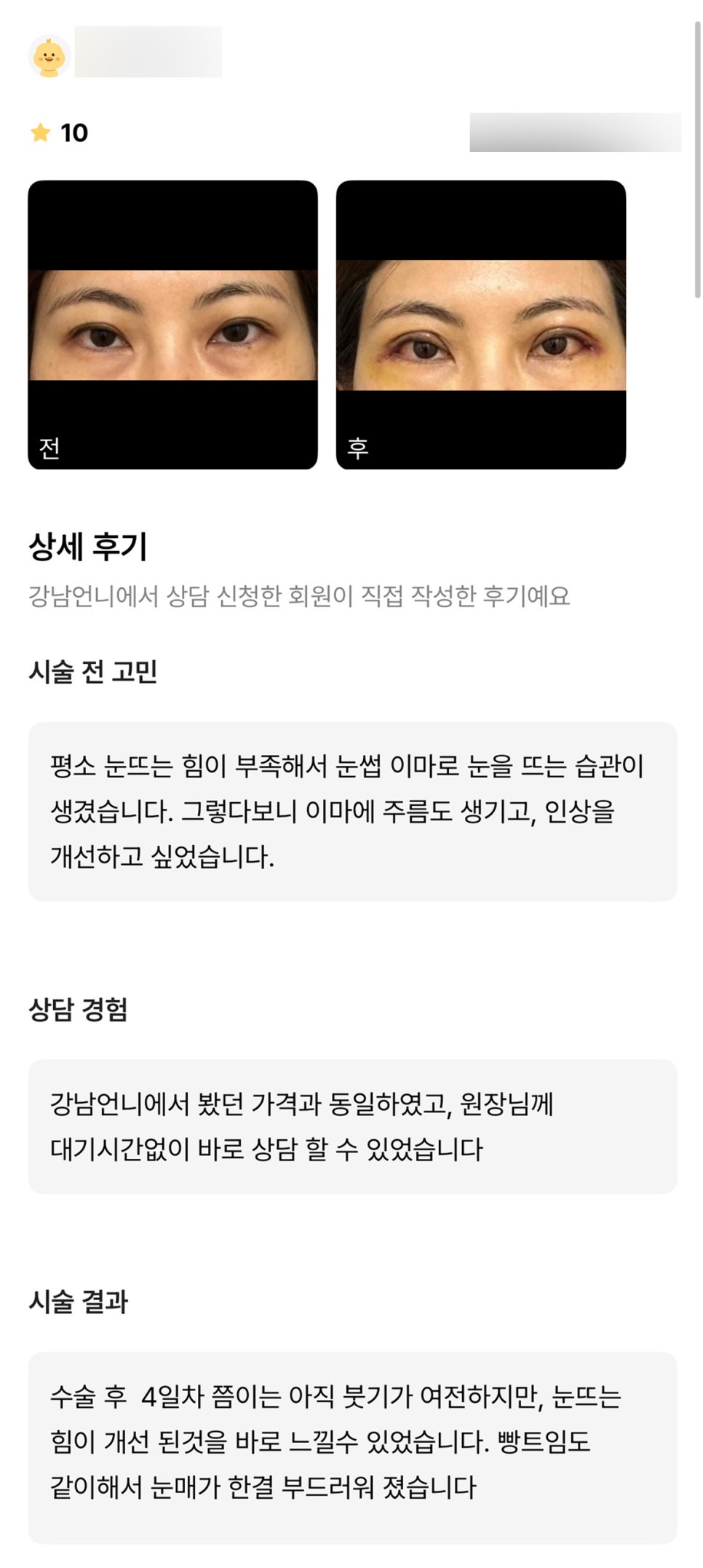 눈성형 후기."눈매가 한결 부드러워졌어요!" 관련 이미지 1