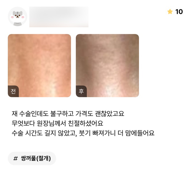 눈재수술 후기."붓기가 빠져가니 더 맘에 들어요!" 관련 이미지 1