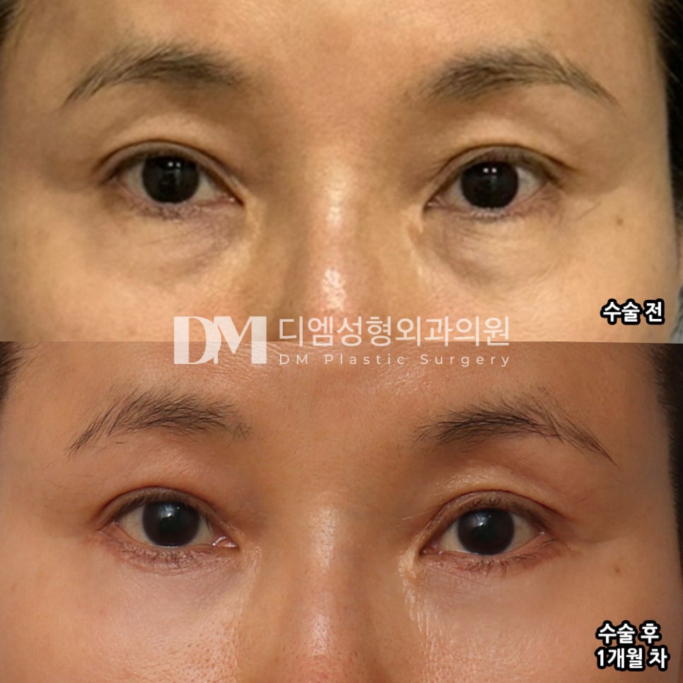 하안검, 밝고 젊어보이는 인상 만들기 관련 이미지 7