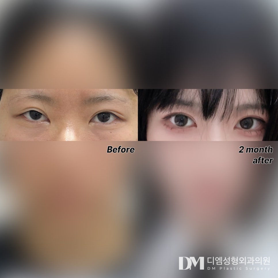 눈재수술 후기."붓기가 가라앉으면 더 예쁠거같아서 기대돼요!" 관련 이미지 2