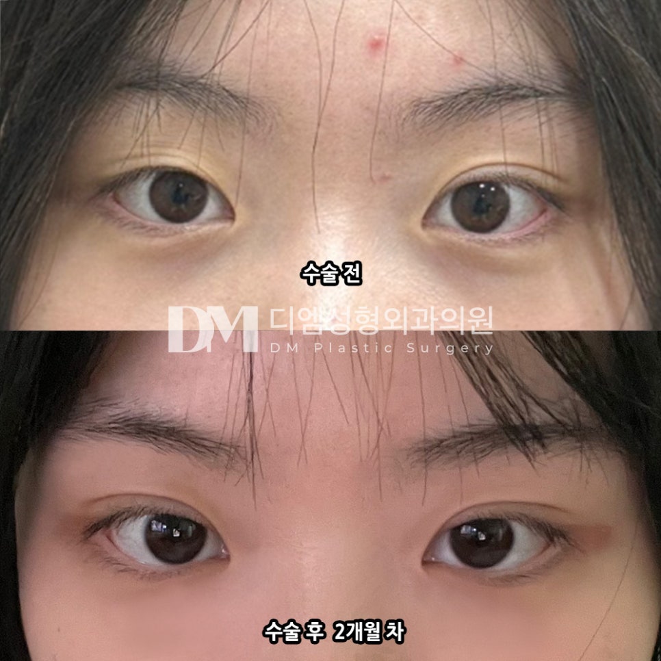 Eyelid Surgery Review. "I’m satisfied because I also like the line!" image 2