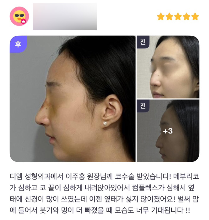 Rhinoplasty Review: “I’m really looking forward to seeing the swelling and bruising go down!” image 1
