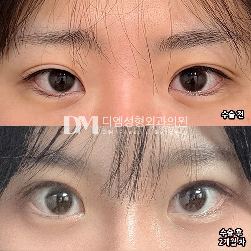 DM Revision Eyelid Surgery Review, “I’m satisfied because my eyes look natural and defined!” image 2