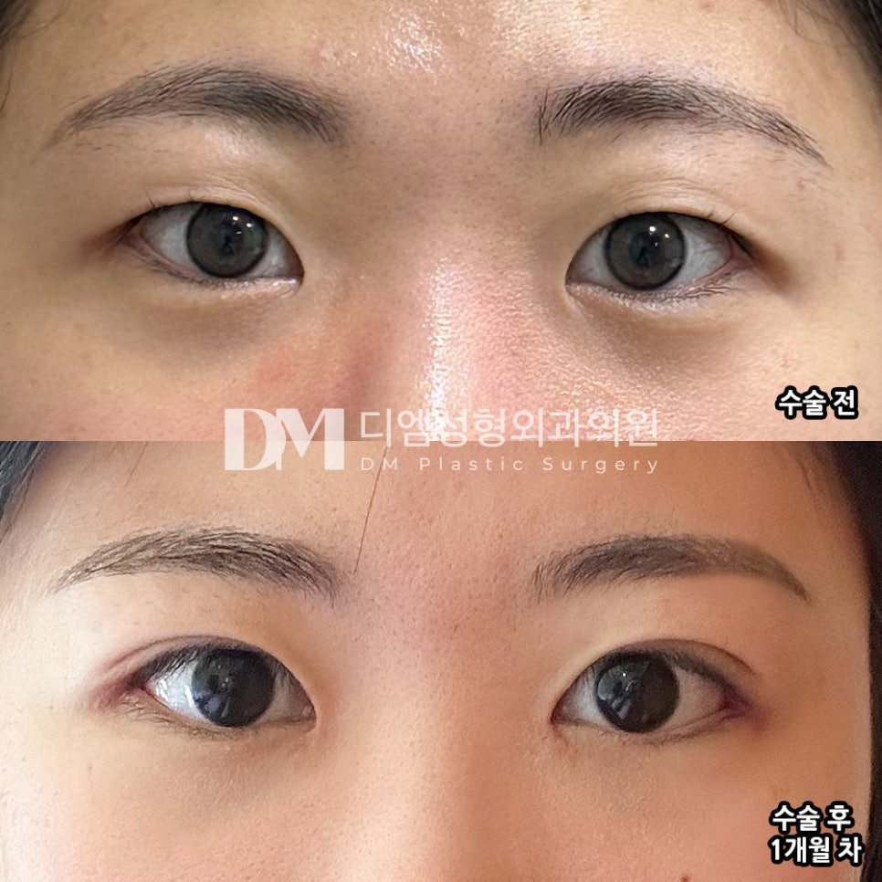 Blepharoplasty Review. "Everyone was kind, and I’m glad the recovery was fast!" image 2