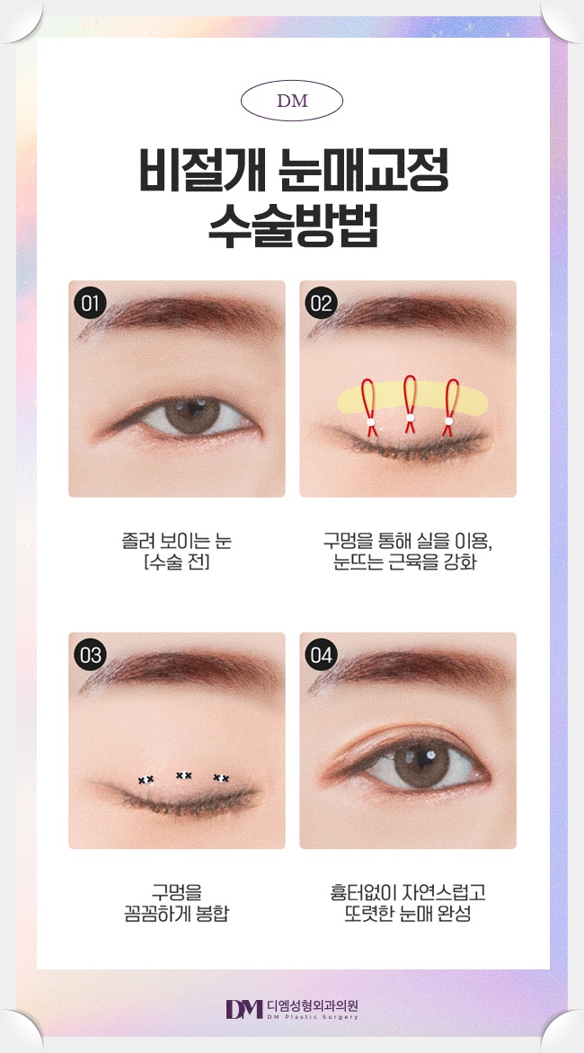 눈매교정, 피곤해보이는 인상 탈출하기 관련 이미지 10