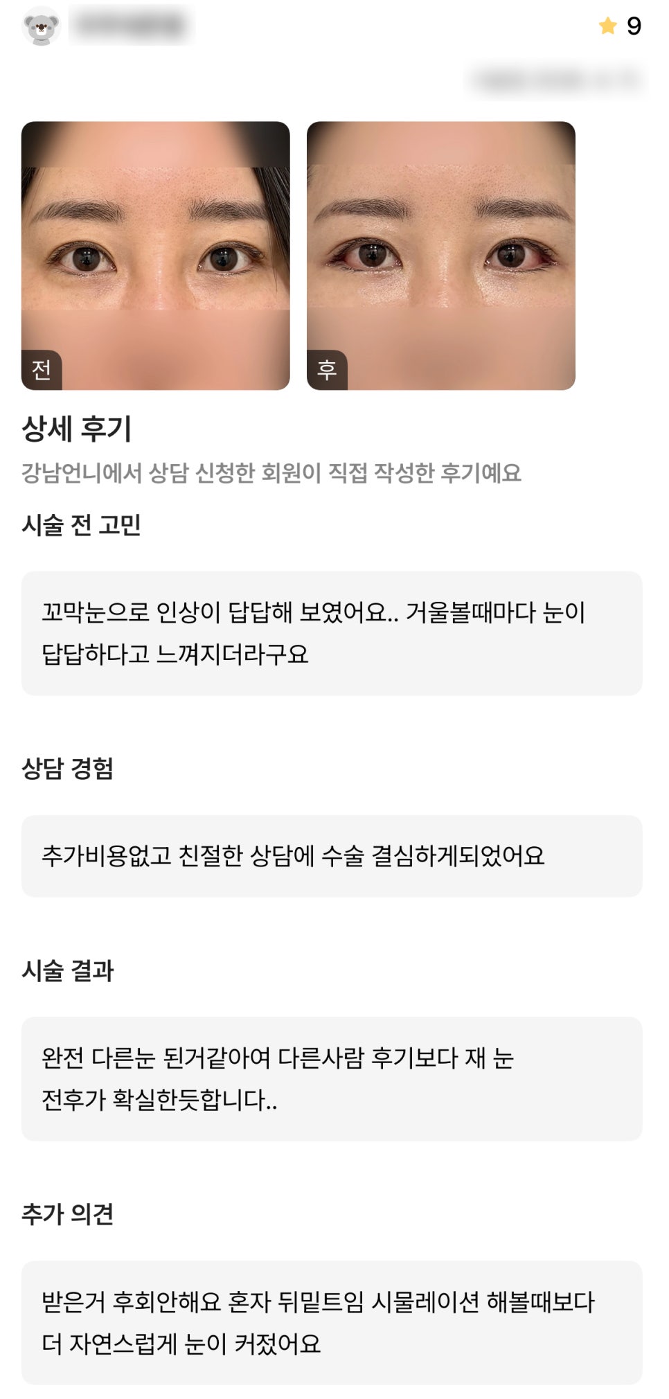디엠 빵트임 수술후기, “완전 다른 눈이 된 거 같아요! 후회 안 합니다!” 관련 이미지 1