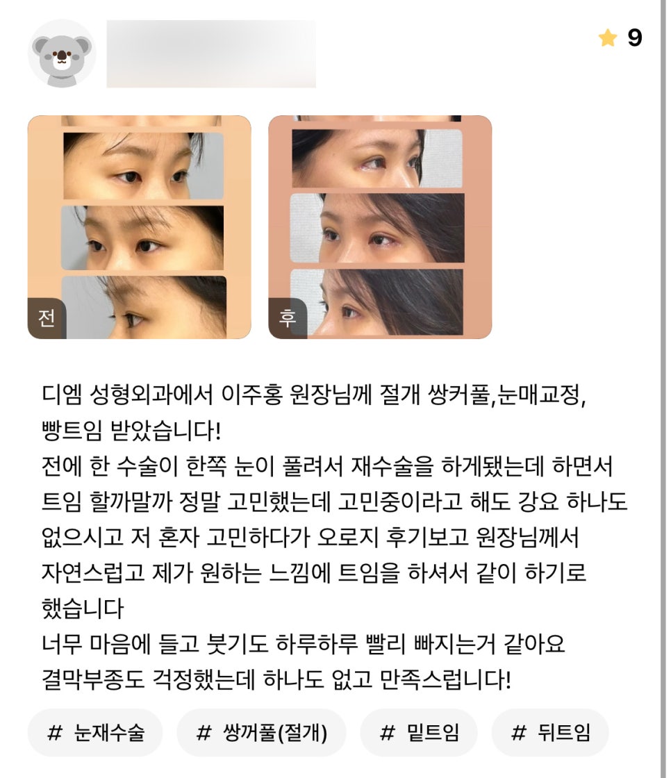 Double-Eyelid Surgery Review: “There was no pressure, and the swelling went down quickly, so I’m very satisfied!” image 1