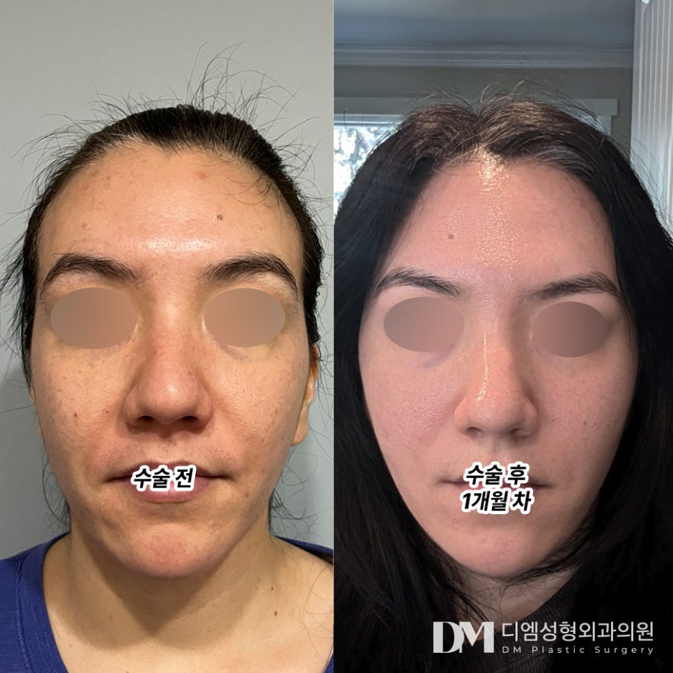 If You’re Worried About a Mini Facelift and Nasolabial Folds! image 7