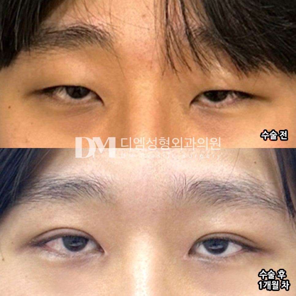 눈성형 후기."자연스럽고 균형잡힌 라인이 마음에 들어요!" 관련 이미지 2