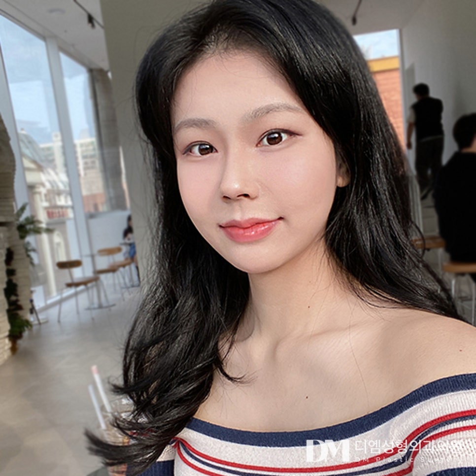 디엠 눈밑지방재배치 전후사진, 칙칙함 싹 지우고 환한 눈매로 변신! 관련 이미지 1