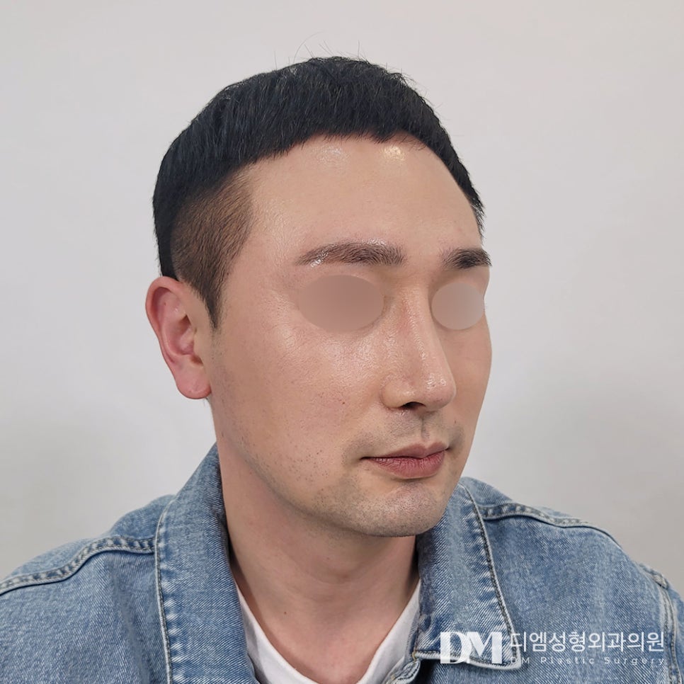 긴코,화살코 성형 코가 길고 끝이 처져 스트레스라면? 관련 이미지 7