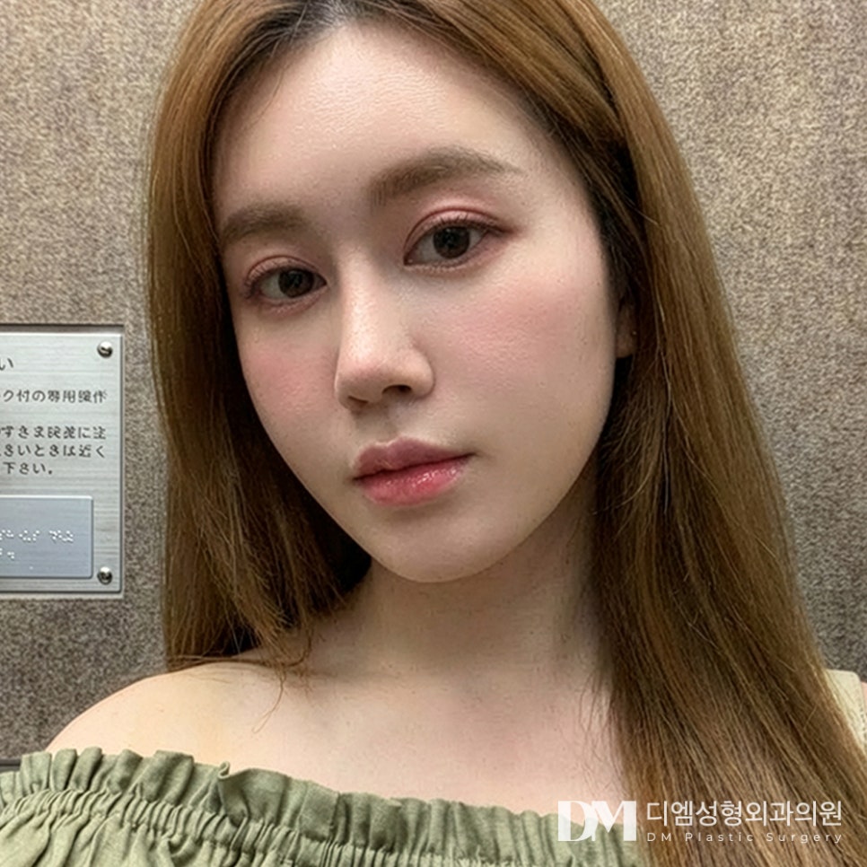 얼굴지방이식, 많이 넣을수록 예뻐질까요? 관련 이미지 2
