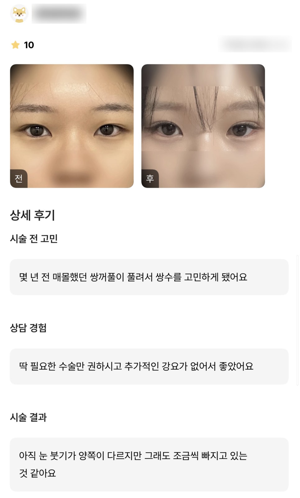 DM Eyelid Revision Surgery Review, “I liked that they only recommended the surgery that was truly necessary!” image 1