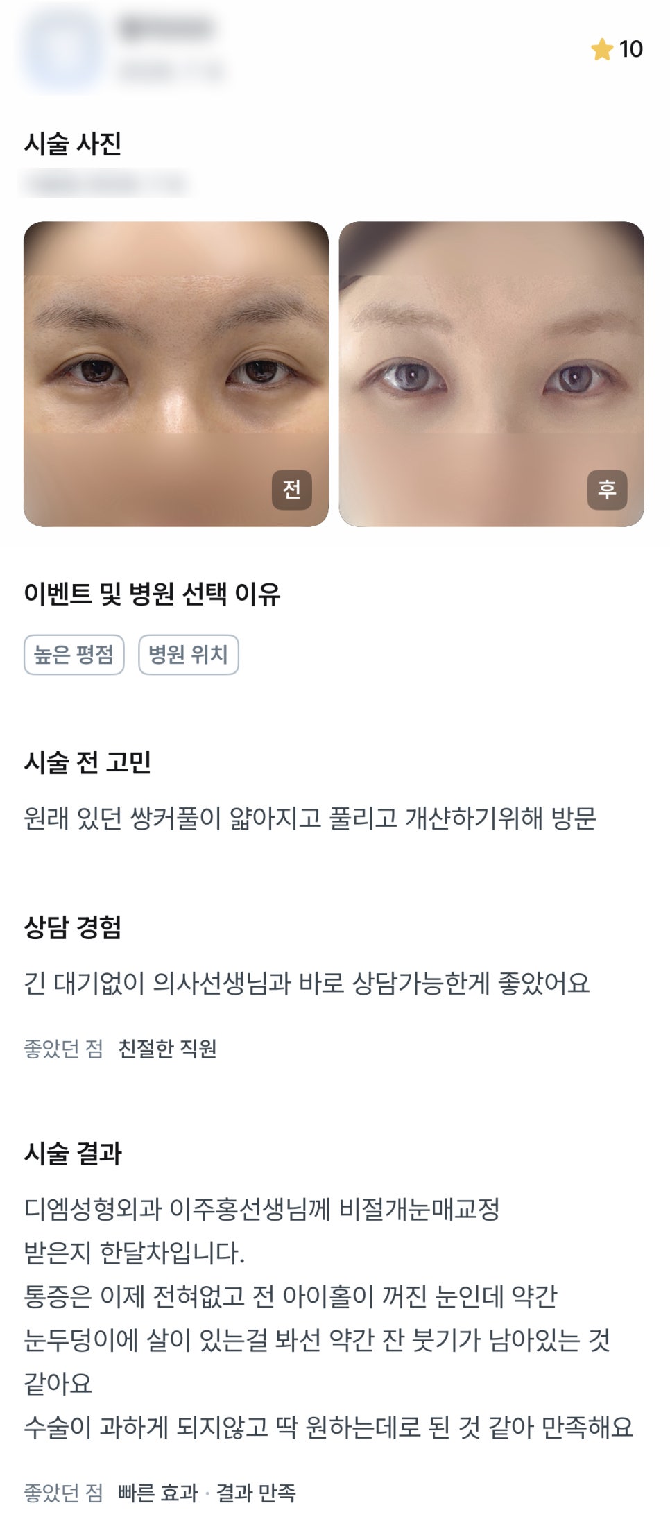 DM Eye Shape Correction/Eye Surgery Review, “I’m satisfied because it turned out exactly as I wanted without being excessive!” image 1