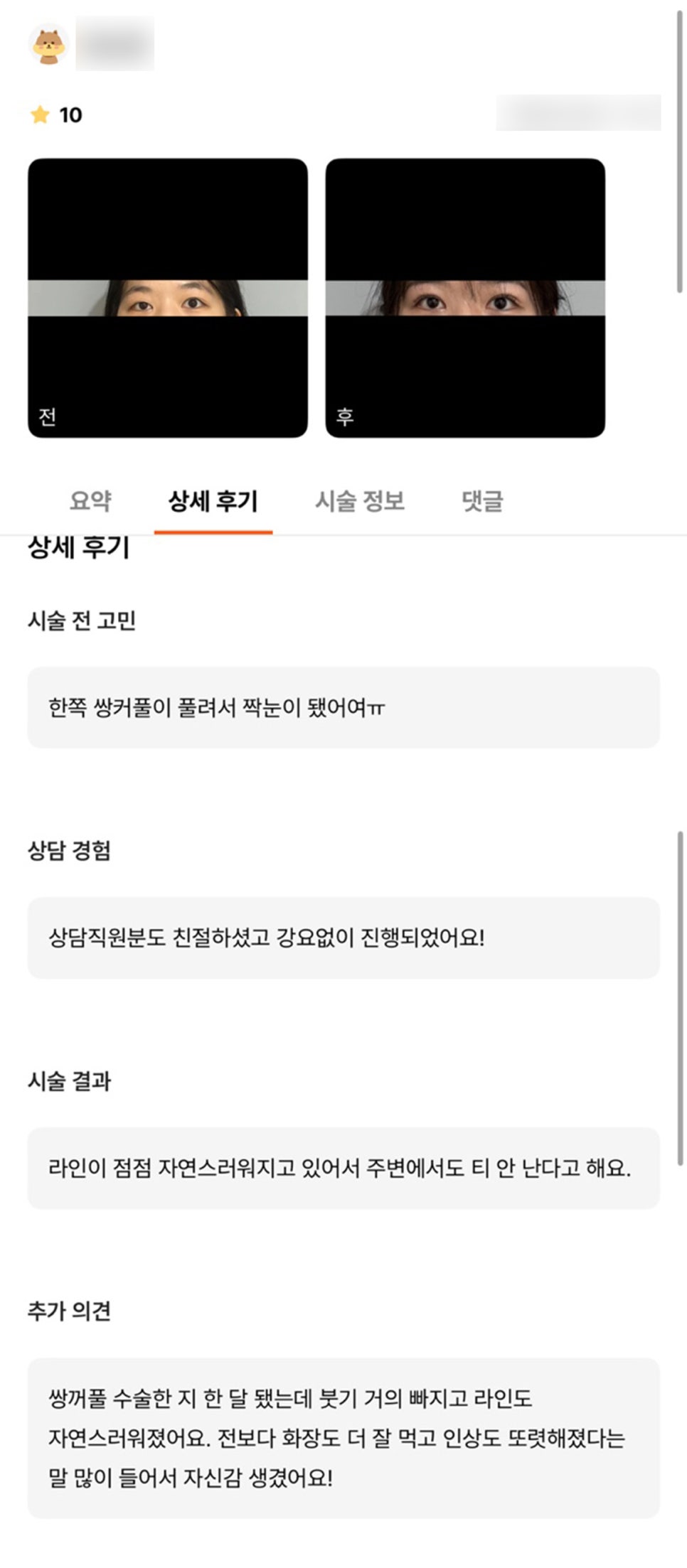 눈재수술 후기."인상도 또렷해졌다는 말 많이 들어서 자신감 생겼어요!" 관련 이미지 1