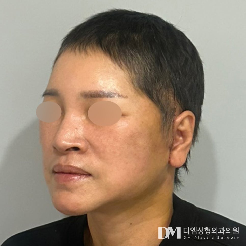 안면거상술 , 중년 처짐 개선하기 관련 이미지 7