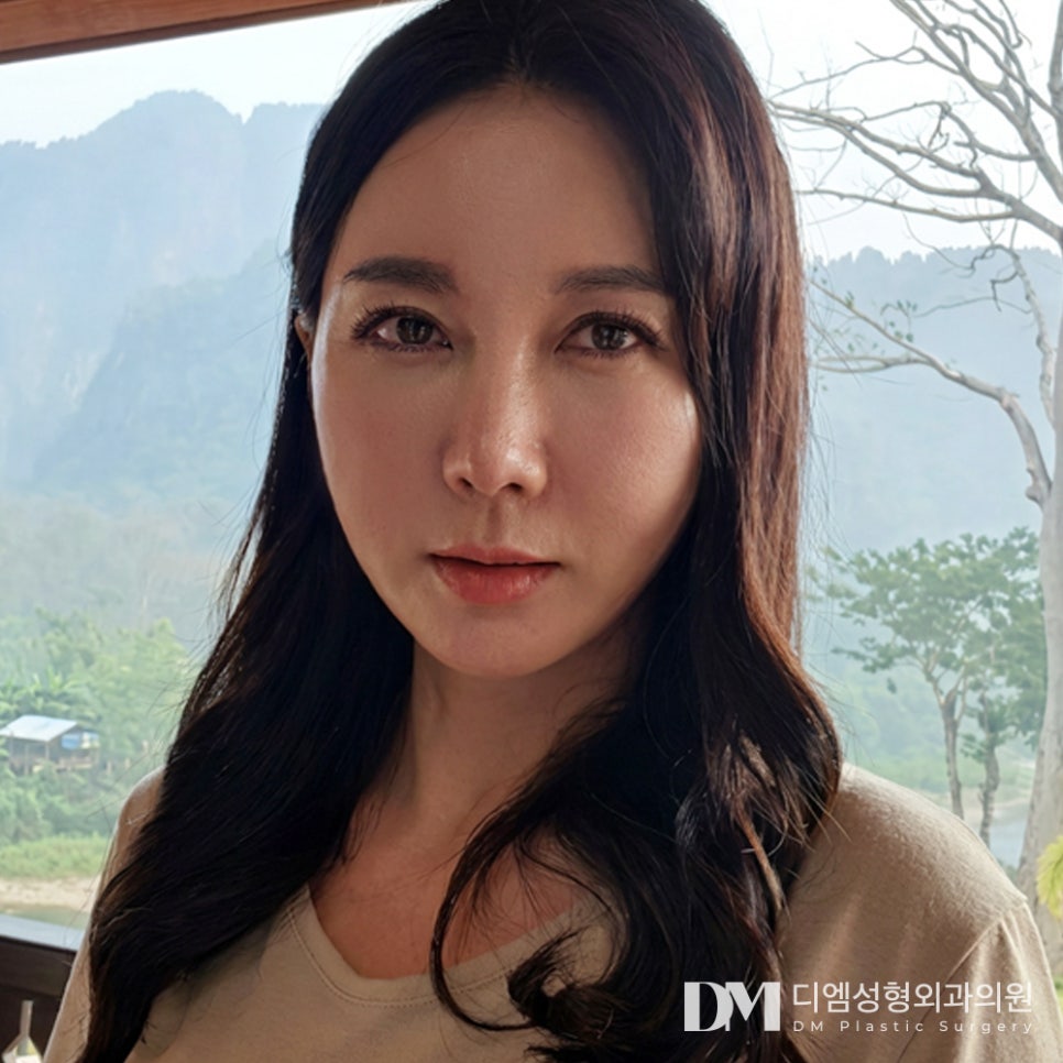 디엠 안면거상 전후사진, 안면거상 시 반드시 체크해야 할 핵심은? 관련 이미지 3