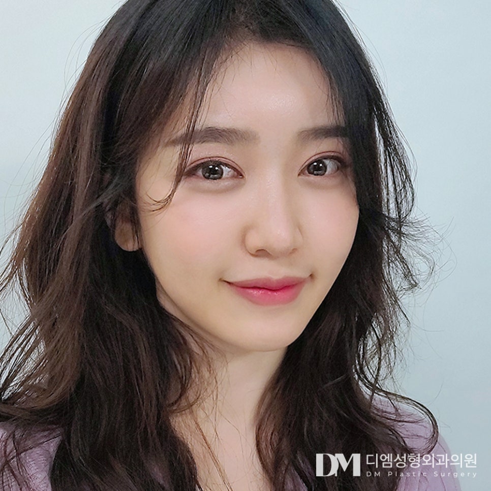 안면거상 나이, 몇 살에 하는 게 가장 효과적일까요? 관련 이미지 7
