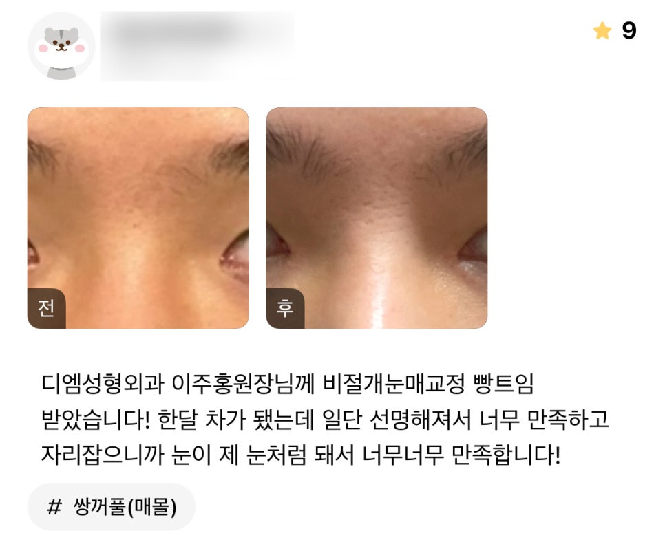 Eye Plastic Surgery Review: “I’m so, so satisfied because it looks natural, as if these had always been my eyes!” image 1